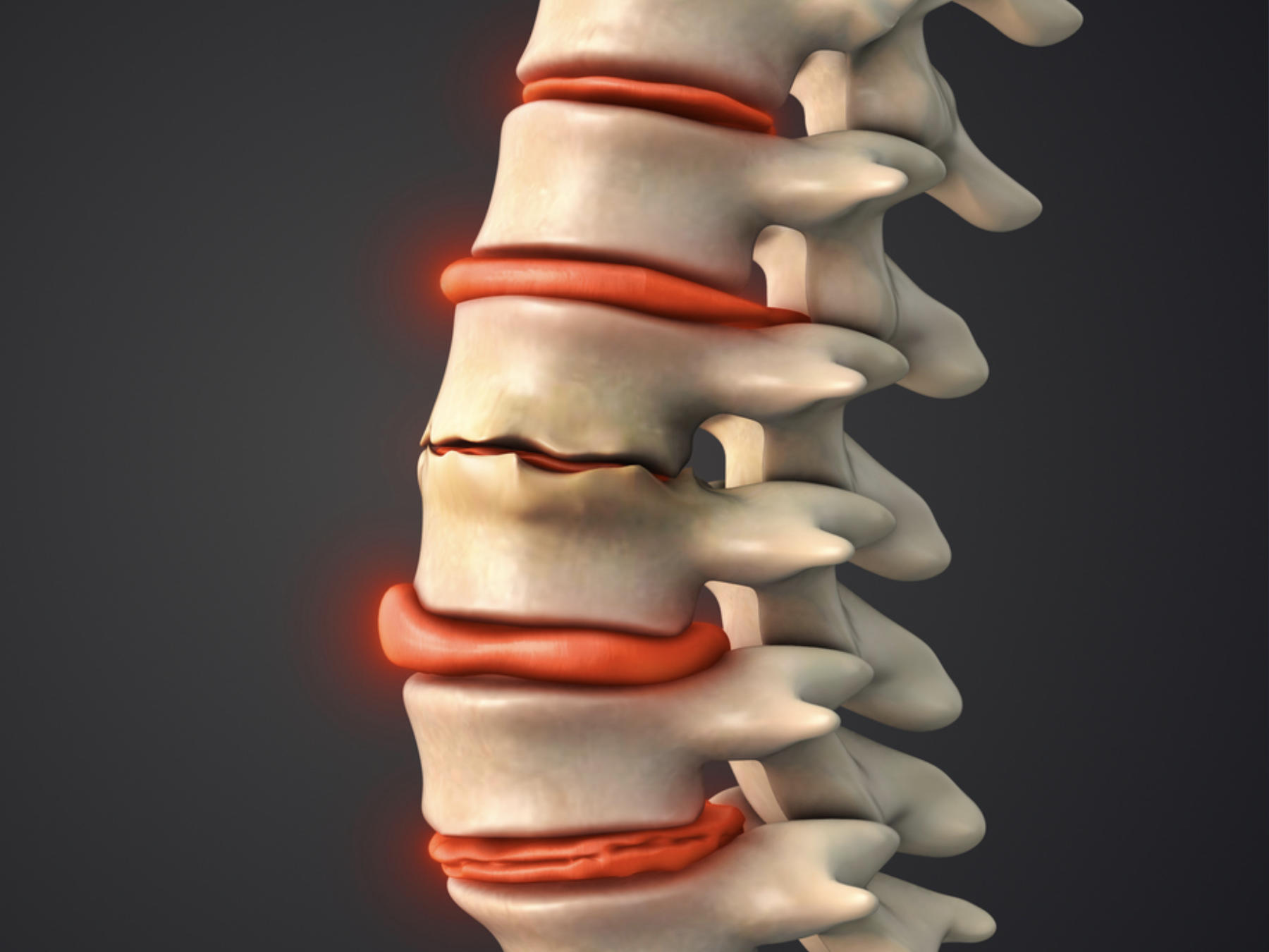Degenerative Disc