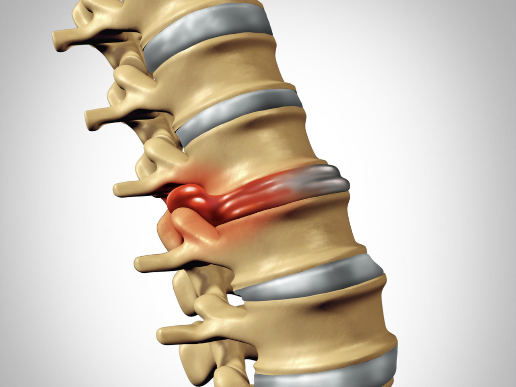 Herniated Disc