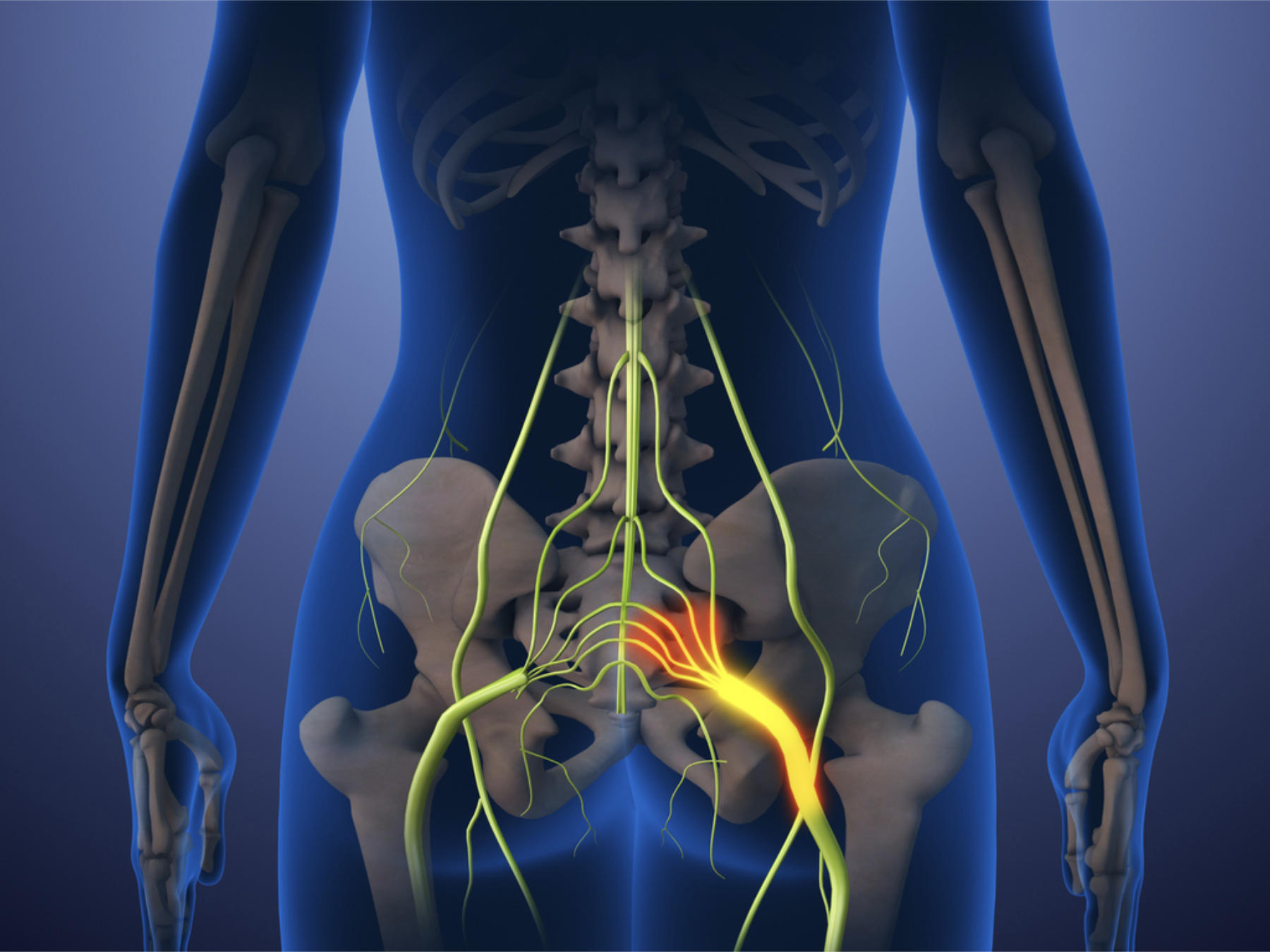 Sciatica